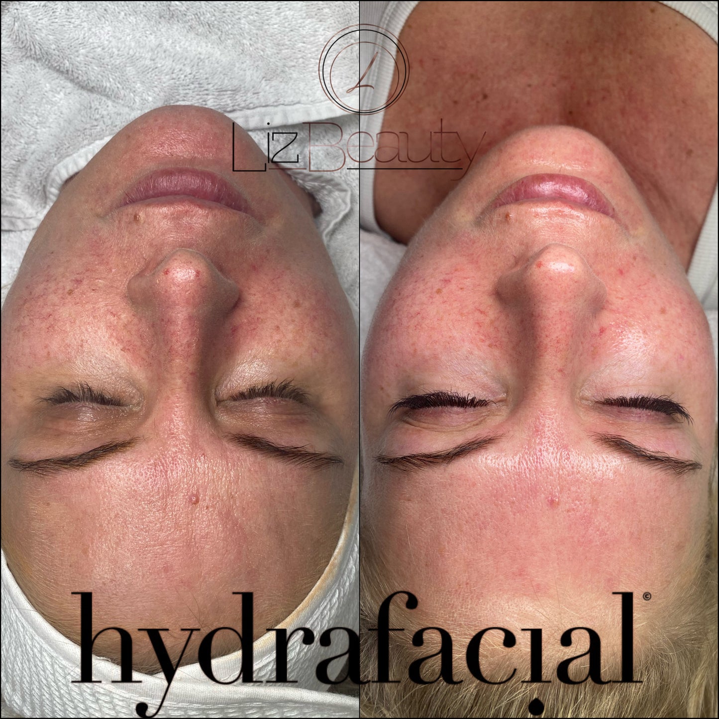 Deluxe HYDRAFACIAL