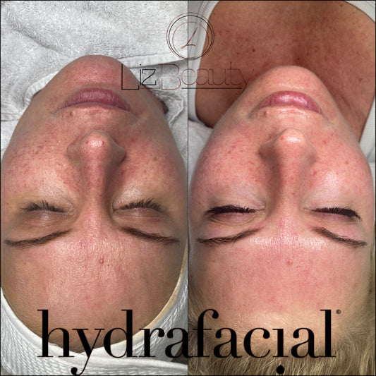Deluxe HYDRAFACIAL