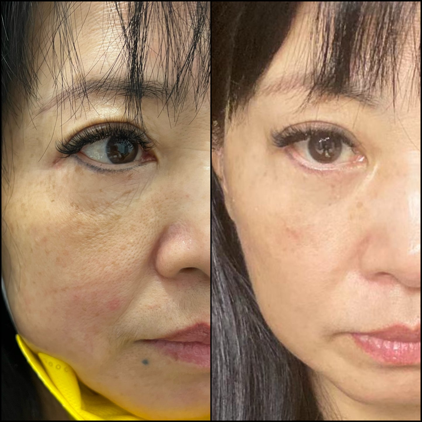 Deluxe HYDRAFACIAL